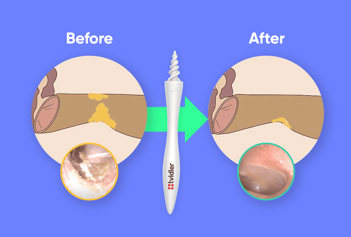 Tvidler before and after results